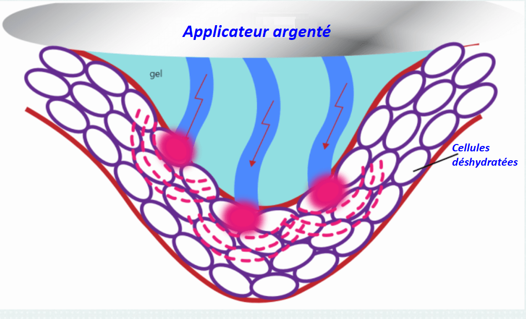 L'Electroporation transitoire réversible un principe pour une nouvelle approche de soins