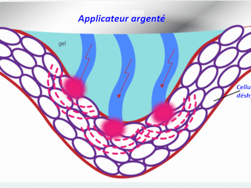 L'Electroporation transitoire réversible un principe pour une nouvelle approche de soins